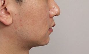 Korean double chin after 2 months with improved contour and defined profile.