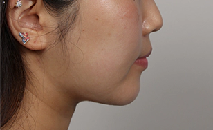 Korean double chin after 2 months with slimmer neck contour and more defined jawline.