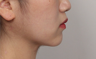 Profile photo of young woman after 2 months with improved jawline and reduced korean double chin.