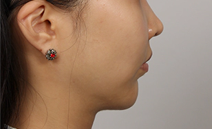 Korean double chin after 2 months showing reduced fat and smoother jawline definition.