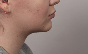 Side profile of female patient after 2 months with improved chin contour and reduced Korean double chin.