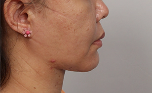 Korean double chin after 2 months showing tightened skin and slimmer neckline.