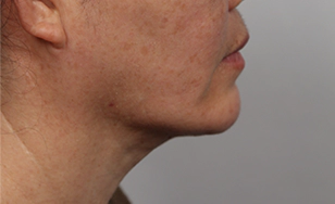 Korean double chin after 2 months with tightened skin, reduced sagging, and improved jawline shape.