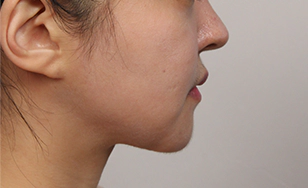 Profile view of woman after 2 months showing sharper jawline and diminished Korean double chin.