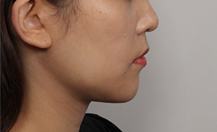 Korean double chin after 2 months with reduced fat and a sharper facial contour.