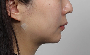 Korean double chin after 2 months showing reduced fat and tightened skin along the jawline.