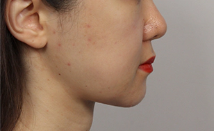 Korean double chin after 2 months with smoother neck profile and more defined jawline.