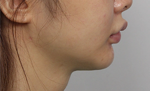 Korean double chin after 2 months with sharper jawline and reduced sagging.
