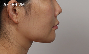 Korean double chin after 2 months with tightened skin, reduced fat, and enhanced jawline shape.
