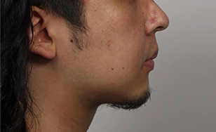 Korean double chin after 2 months with sharper chin angle and reduced fat.