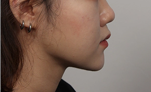 Side view after 2 months with defined chin contour and reduced korean double chin appearance.