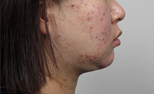 Korean double chin after 2 months with tightened neck contour and visible jawline.