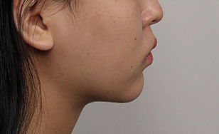 Korean double chin after 2 months showing slimmed profile and improved definition.