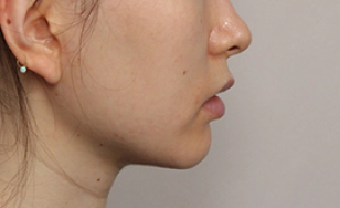 Korean double chin after 2 months with smoother neckline and enhanced jawline contour.