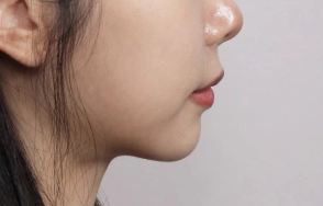 Slim and smooth jawline and neckline.