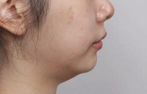Female in their 20s with double chin.