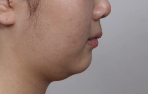 Female in their 30s with double chin.