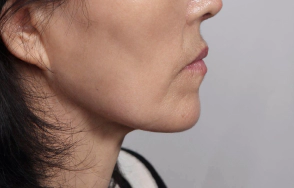 Smooth, sharper jawline after plastic surgery.