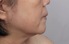 Female in their 40s with sagging double chin and jowl lines.