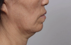 Female in their 50s with sagging double chin and sagging neck and face.