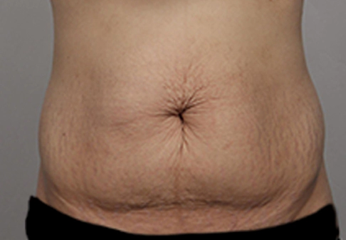 Abdomen with many wrinkles and folds.