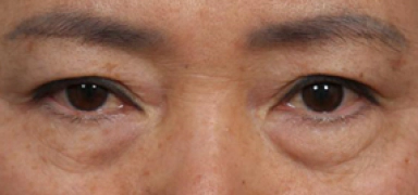 Under eyes that protrude and sag needed of lower blepharoplasty surgery.