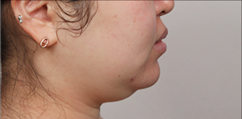 Female with short chin due to Korean double chin.