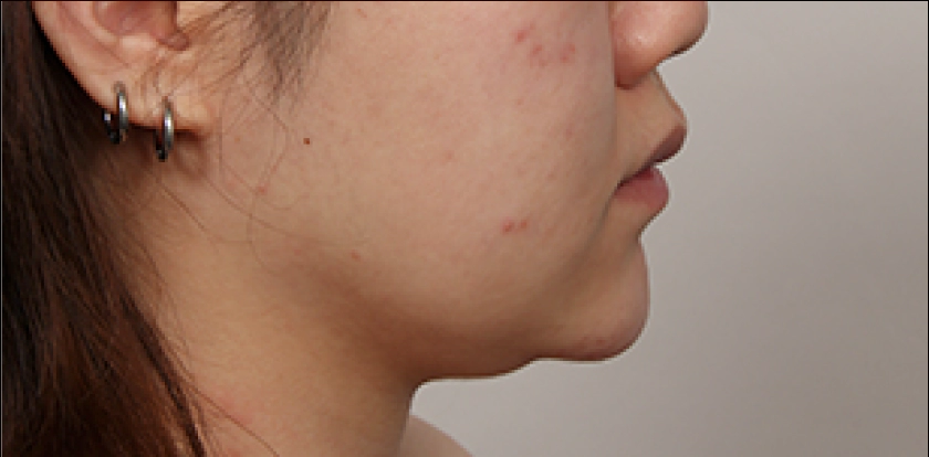 Profile view of a young woman with short chin length showing korean double chin appearance before correction.