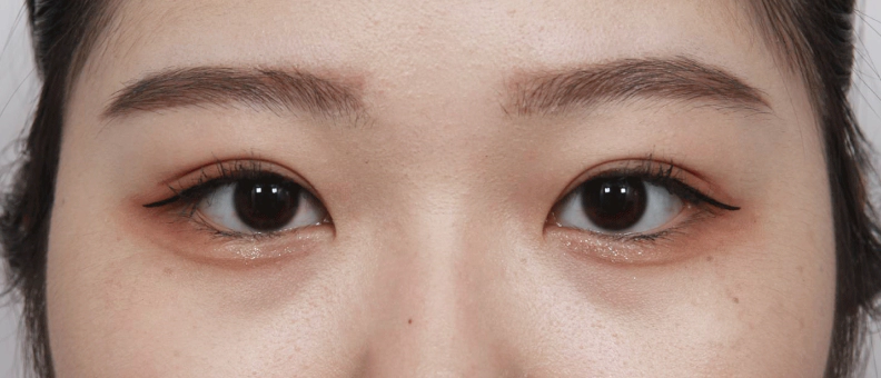 불룩한 눈위의 지방 제거후 쌍꺼풀 수술로 예뻐진 눈.