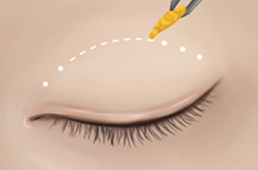 흉터 없이 쌍커풀 수술중 지방 제거.