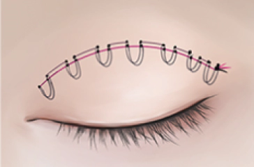 이중 매몰법으로 단단한 쌍커풀 라인 만드는 법.