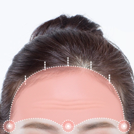 내시경 이마거상술로 박리하는 범위.