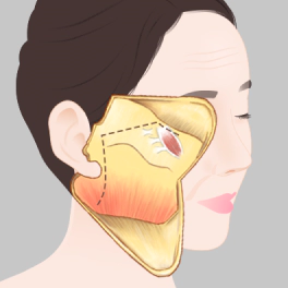Korean facelift incision that follows hairline and ear crease.