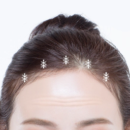 이마거상술후 봉합하는 위치.