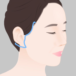 Last suturing step of Korean facelift.