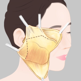 Lifting all layers of smas and skin for effective Korean facelift.