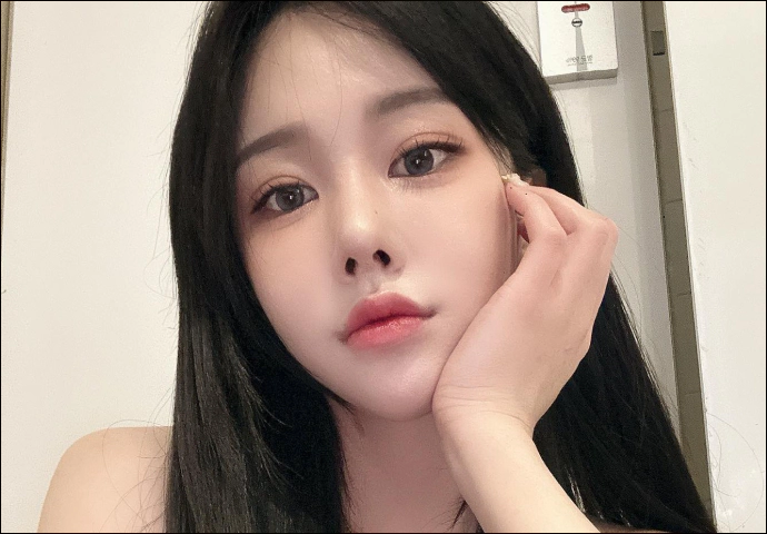 Double eyelid surgery results with ptosis correction.