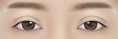 이전 눈 수술후 라인이 너무 두꺼운 경우.