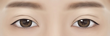 이전 수술로 라인이 어울리지 않는 경우.