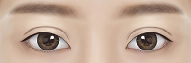 이전의 수술로 라인이 부자연스러운 경우.