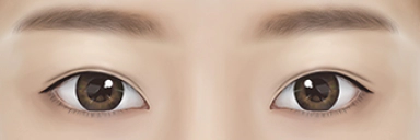 눈재수술과 안검하수 수술로 또렸해지고 예뻐진 눈.