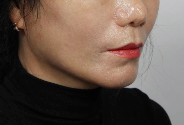 Lifted smile lines and jowls after Korean facelift surgery.