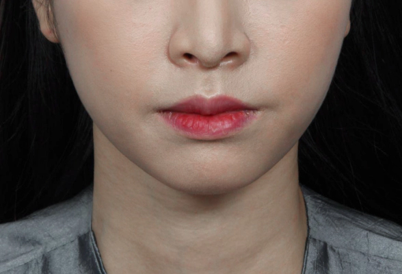 실 리프팅 시술후 날렵해진 턱 라인.