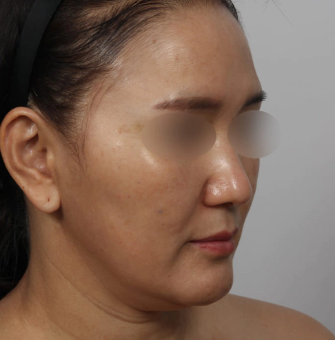 Korean neck lift before photo showing sagging skin under the chin and visible neck lines.