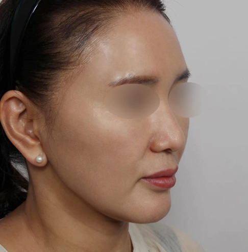 Korean neck lift after photo with tightened jawline, smoother neck, and improved contour.