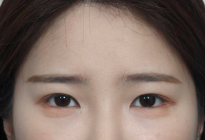 눈썹을 이마거상술로 올린 모습.