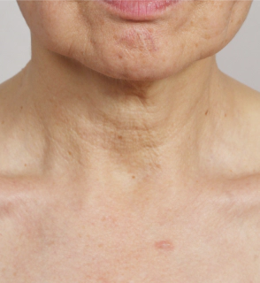 Korean neck lift before photo highlighting loose skin and prominent neck lines.