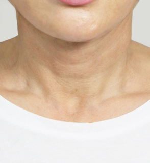Korean neck lift after photo with smoother neck skin and reduced wrinkles.