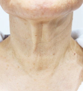 Korean neck lift before photo showing deep vertical lines, sagging skin, and visible neck folds.
