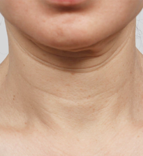 Korean neck lift before photo highlighting excess skin, double chin, and horizontal neck lines.